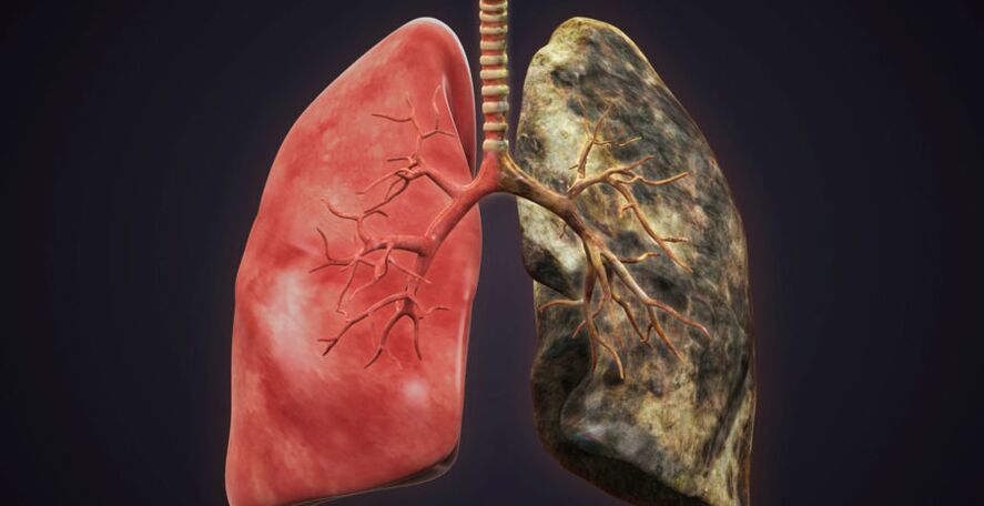 белия дроб на пушача и се откажете от пушенето на белия дроб